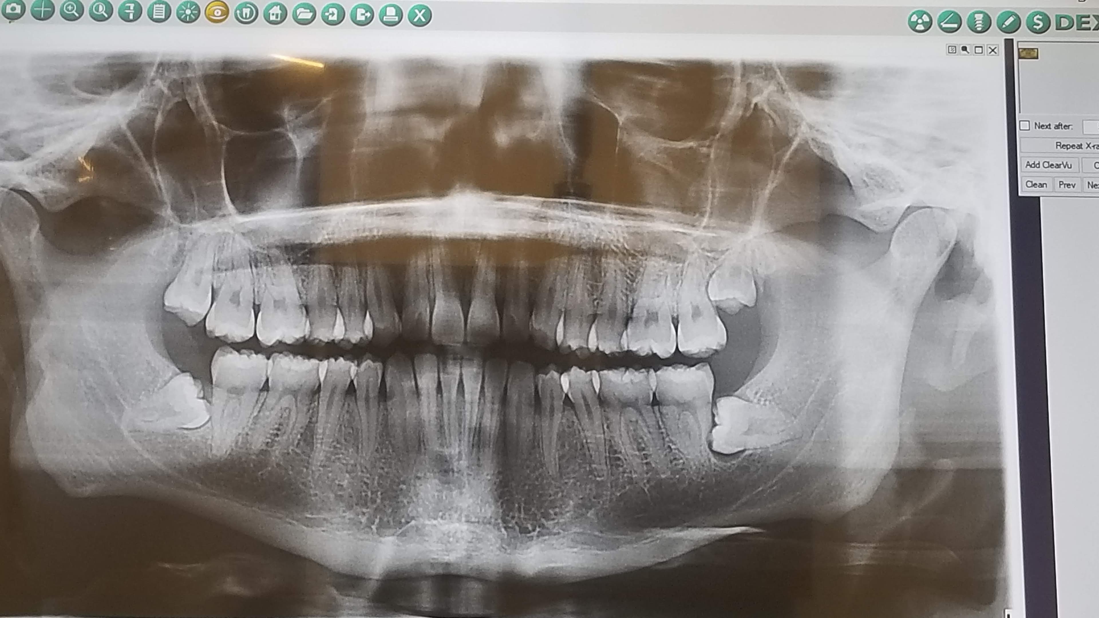 X-ray of the author's wisdom teeth, taken before extraction.